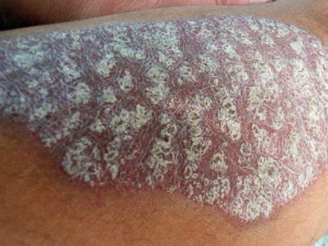 ECZEMA AND HOMEOPATHIC TREATMENT eczema can 100% cure by homeopathic medicine and give permenant… post image