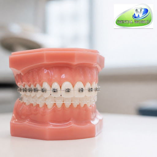 Thinking about straightening your teeth but confused between metal braces and ceramic braces? At…