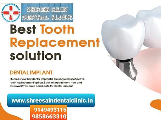 Dental Implants post image