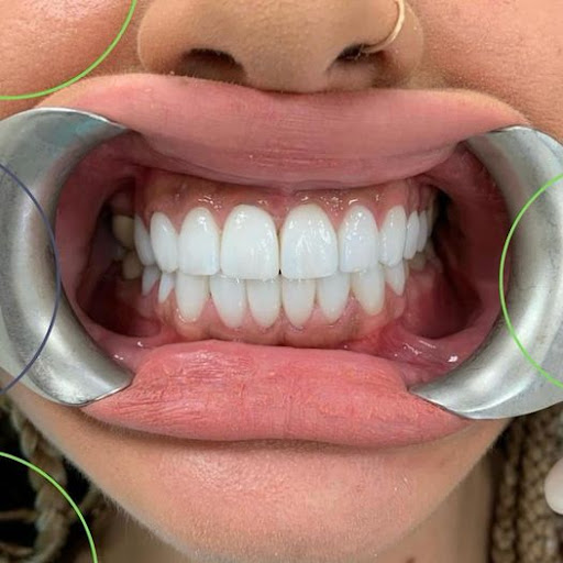 Krown Dental - Dentist Merrylands - Thumbnail