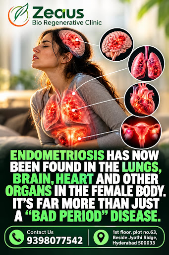 Endometriosis post image