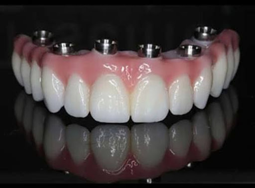 Dental Implants in Loni – Restore Your Smile post image