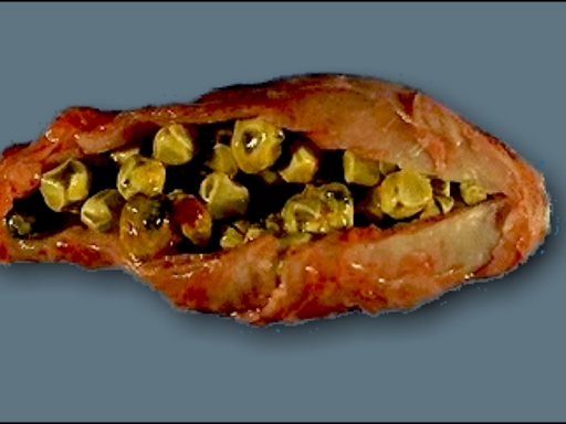 GALL STONE.are you suffering from gall stone? homeopathic treatment is best treatment for gall st… post image