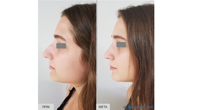 Comentarii opinii despre Ρινοπλαστική / Πλαστική Μύτης - Μιχάλης Τσούνης MD, PhD-Αθήνα