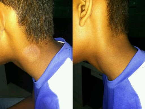 Fungal infection ? Are you suffer from fungal infection ?than why are you waiting ? Homeopathic t… post image