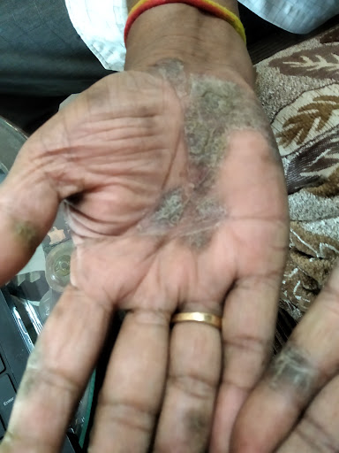 Excema of hands.jalwat.Ayurveda has good medicine and ointments. post image