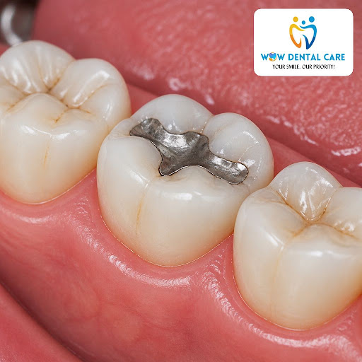 Worried about a cavity getting worse? Dental fillings are a simple, effective way to stop tooth d… post image