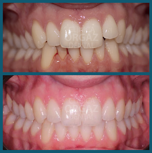 Clínica Dental Orgaz Usera - Dentistas - Implantes dentales