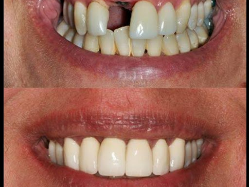 Best dental care for missing teeth