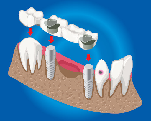 Dental implant restoration is a reliable solution for replacing missing teeth, offering improved… post image
