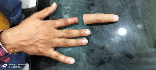 Artificial finger in thane 