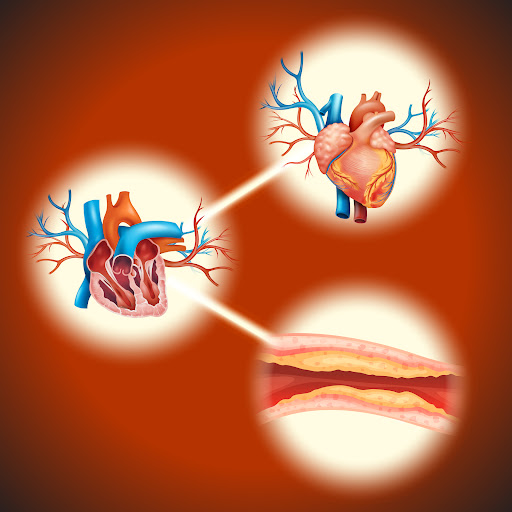 Acute Myocardial Infarction (AMI), commonly known as a heart attack, occurs when blood flow to th…