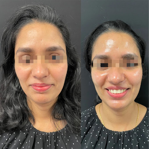 Hydrafacial for Instant Glow post image