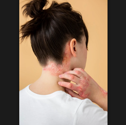 Seborrhea is a common skin condition that can lead to excessive oiliness, flaking, redness, and i… post image