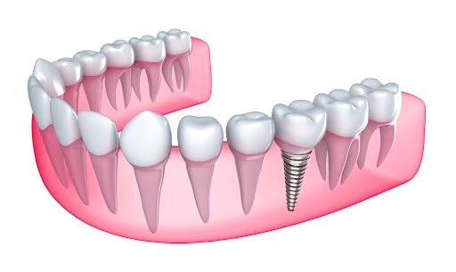 Transforming smiles with precision and care, Vardan Dental Clinic in Satellite, Ahmedabad is your… post image