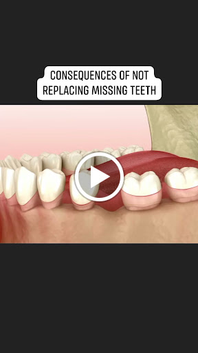 🦷 Disadvantages of Missing Teeth post image