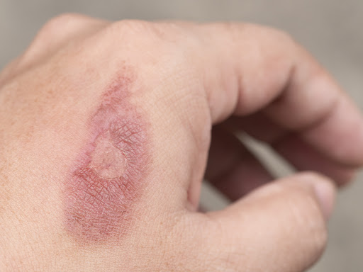 Skin burns can occur due to heat, chemicals, electricity, or prolonged sun exposure. They may ran… post image