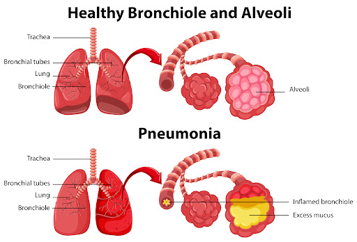 Understanding PAP is crucial for effective management. Symptoms may include persistent cough, sho…