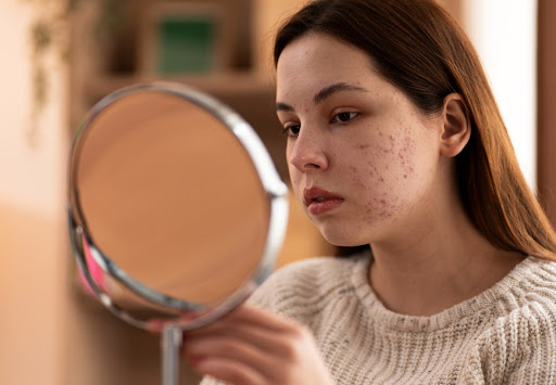 Managing acne scars effectively requires tailored treatment options and professional care. At Dr.…