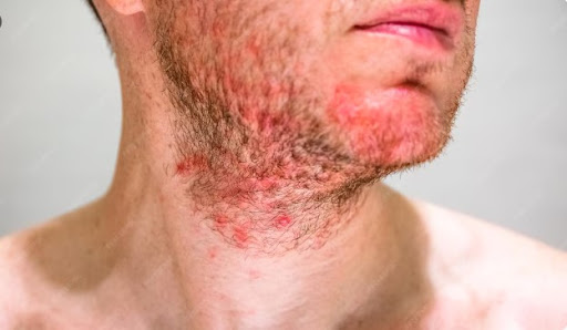 Seborrheic Dermatitis is a common skin condition that may cause redness, itching, flaky skin, and… post image
