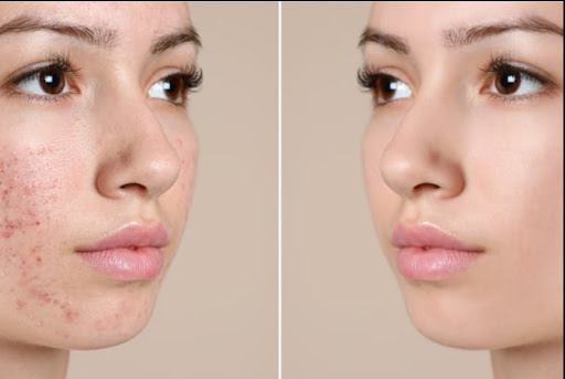 ✨ Say goodbye to stubborn acne scars with the most advanced Acne Scar treatment in Mumbai at Rege…