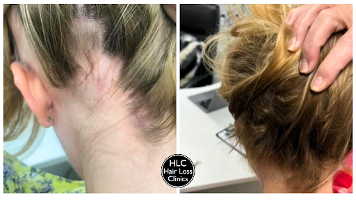 Cardiff Hair Loss Clinic - Thumbnail