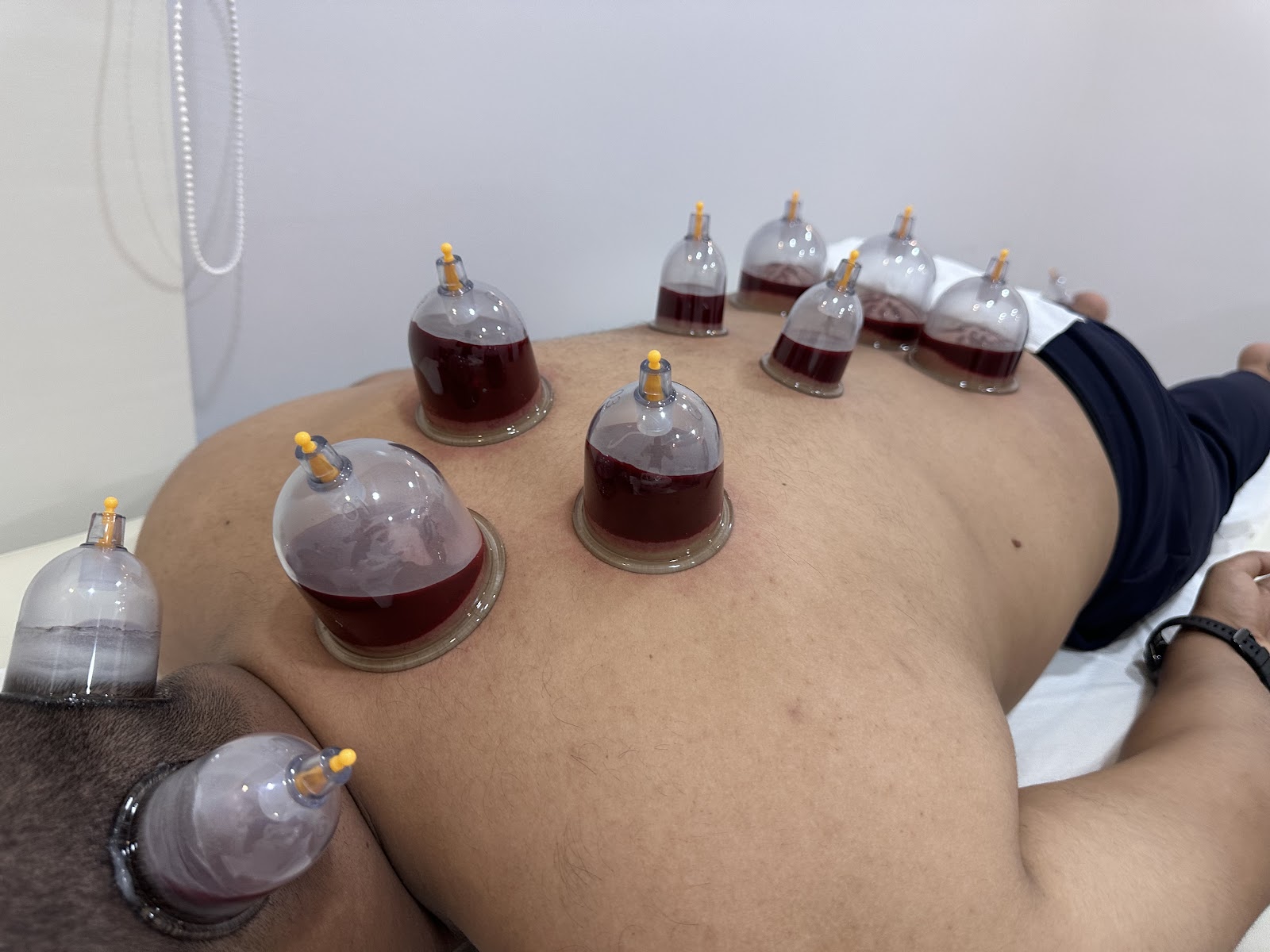 حجامة منزلية - صورة 2