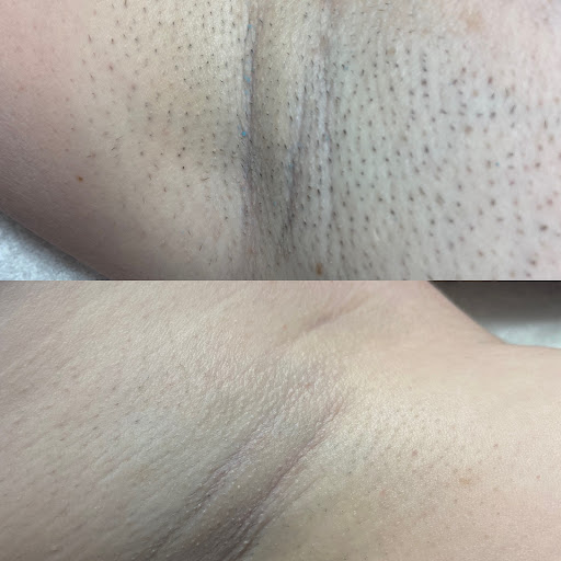 Smooth and Remove - Visual