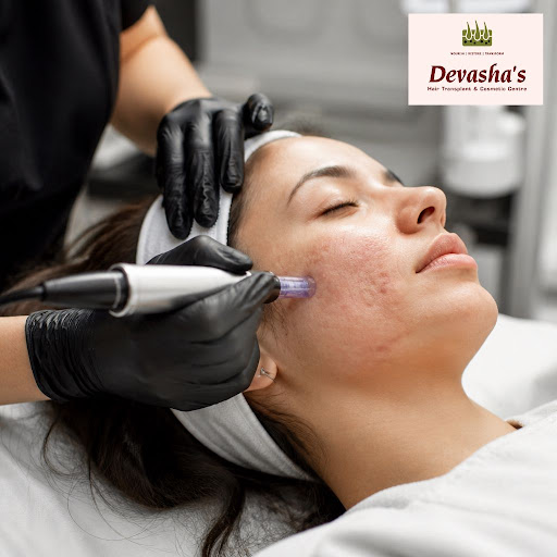Stubborn acne marks affecting your confidence? At Devasha's Hair Transplant And Cosmetic Centre -…