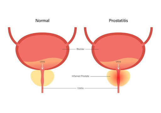 Prostatitis is a condition involving inflammation of the prostate gland, which can affect men of… post image