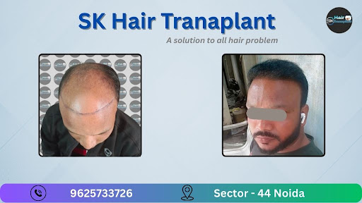 Are you struggling with hair loss or baldness? Visit SK Hair Transplant Clinic in Sector 44, Noid…