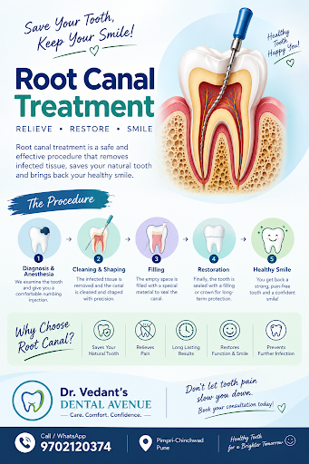 Root Canal treatment post image