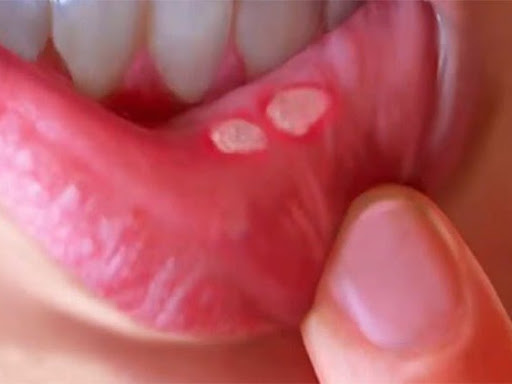 MOUTH ULCER. post image