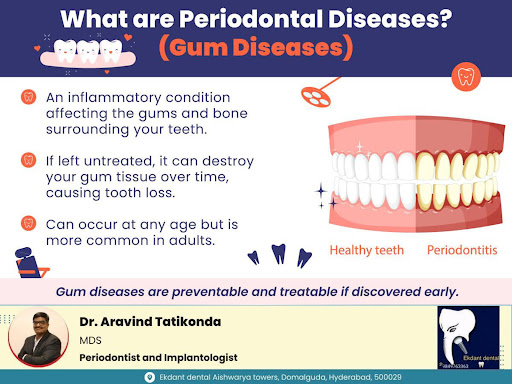 Periodontal diseases, commonly known as gum diseases, are a group of conditions that affect the t… post image