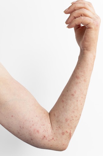 Photodermatitis is a skin reaction triggered or worsened by exposure to sunlight. It may cause re…