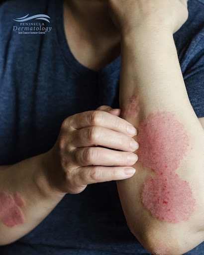 Struggling with Psoriasis, Eczema, or chronic skin rashes? G