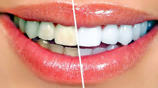 Brighten Your Smile – Instantly! post image