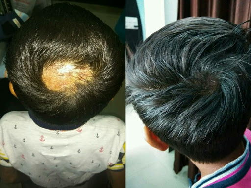 HAIR FALL -ALOPECIA- FOR HOMEOPATHIC TREATMENT post image