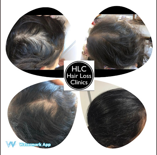 Cardiff Hair Loss Clinic - Thumbnail