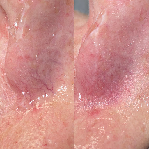 Smooth and Remove - Visual