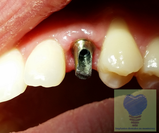 Implantes Dentales en Monterrey Dr Xavier Madrigal