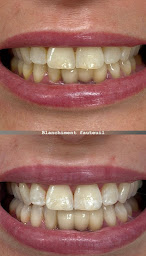 Photo n°19 de Dentiste Bellaiche, Implant, Facette, Laser, Kremlin-Bicêtre à Le Kremlin-Bicêtre (Service de blanchiment des dents)