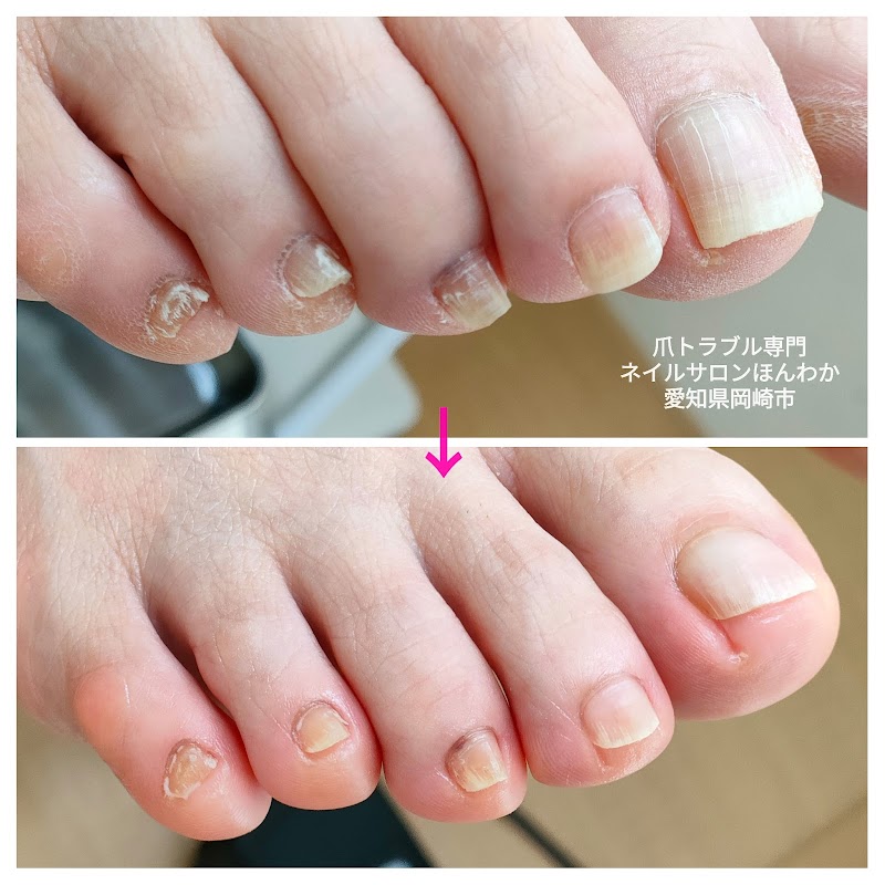 足爪トラブル専門ネイルサロンほんわか