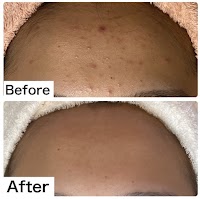 会津若松のニキビ専門フェイシャルサロンAmicalique