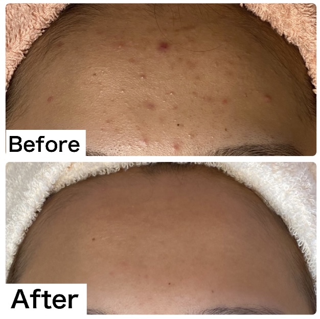 会津若松のニキビ専門フェイシャルサロンAmicalique