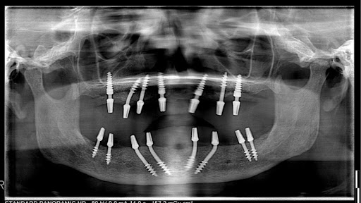 Corticobasal implants allow rehabilitation even in challenging bone conditions, helping patients… post image