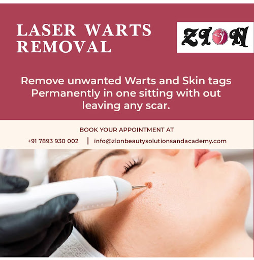 20% off on laser warts removal service post image