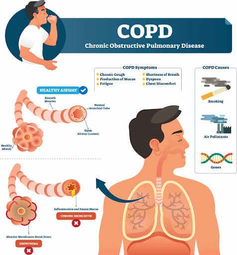 Chronic Obstructive Pulmonary Disease (COPD) ek serious lung disease hai jo smoking ya pollution…
