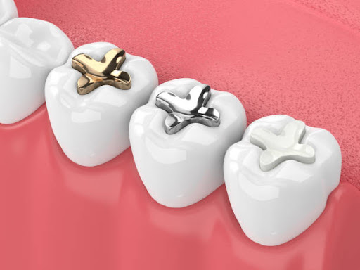 When comparing cosmetic dental filling vs. composite filling � which is better, it helps to under…