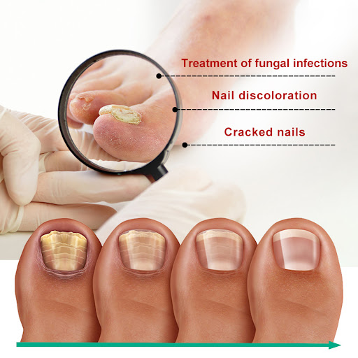 Title 3, Gentle Repair for Raw, Rotten Toenails. Get Rid...